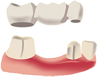 Dental Bridges